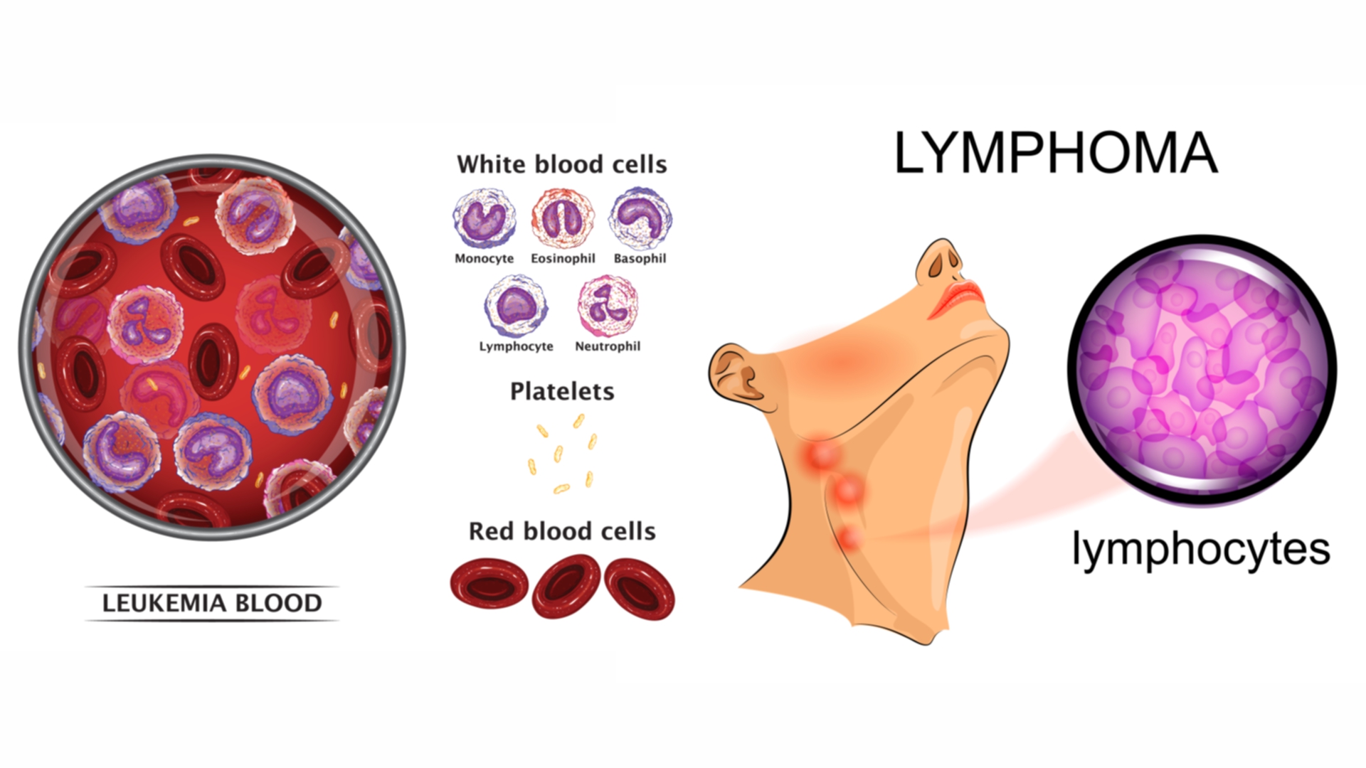 Leukemia and Lymphoma